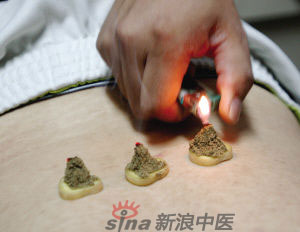灸法的種類  你知道多少？
